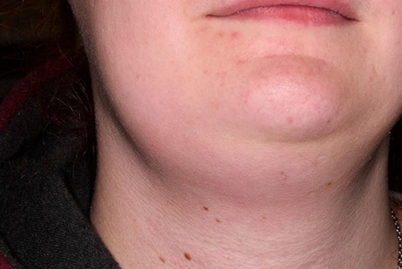 swollen lymph node back of neck