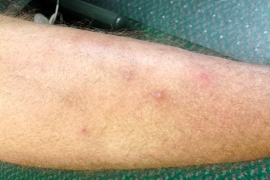Tender nodules were appearing on the patient's lower legs