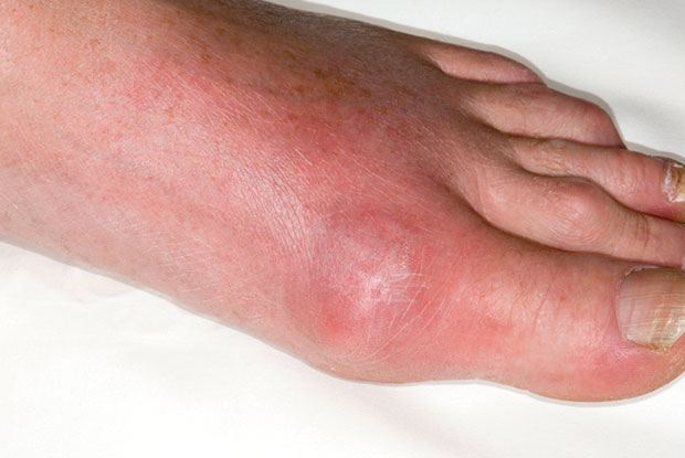 Managing Patients With Gout Gponline