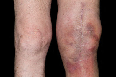 Complications After Total Knee Replacement Surgery Gponline