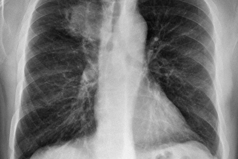 breath-temperature-can-help-diagnose-lung-cancer-gponline