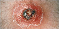 A skin abscess may develope after a minor wound