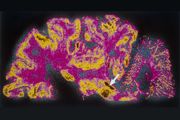 MRI scan of a brain showing Parkinson's disease (Photo: Science Photo Library)
