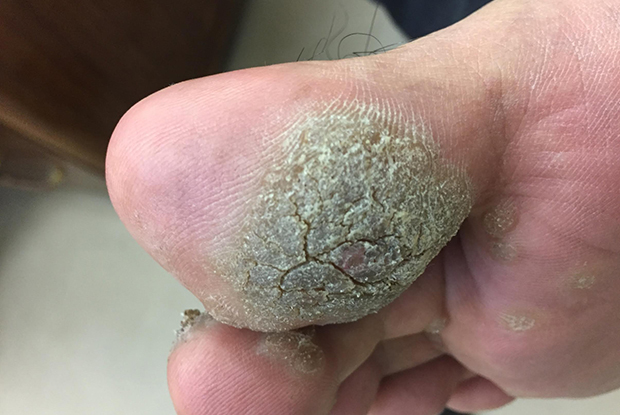 wart after virus