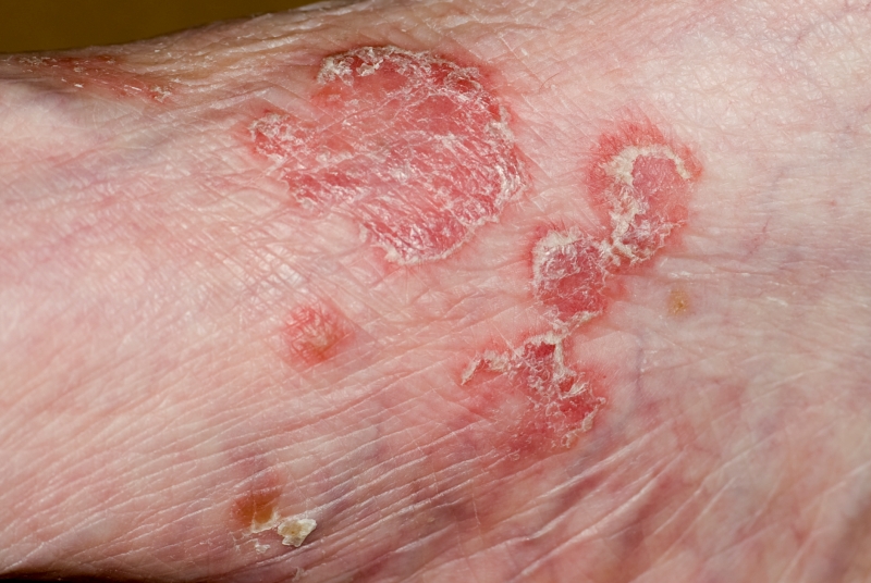 psoriasis nhs