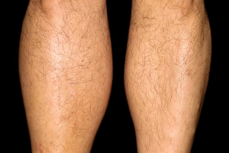 is-one-leg-swelling-a-sign-of-vascular-disease-cvm