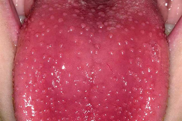 Scarlet fever: Symptoms to look out for and how to treat
