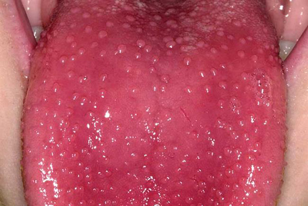 Scarlet Fever: What it Looks Like and What Causes it