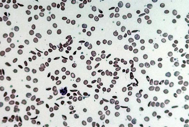 hemoglobin sc disease blood smear
