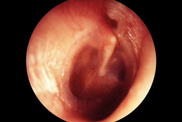 Diagnosis, Natural History, and Late Effects of Otitis Media with