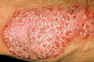 Journals Watch Psoriasis statins and flu vaccine GPonline