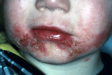 Streptococcal infections |
