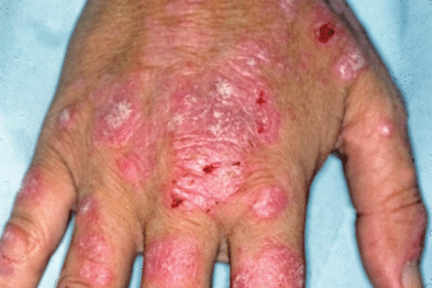 lupus rash on hands