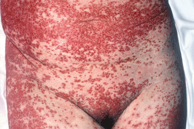 Erythroderma secondary to toxic shock syndrome.