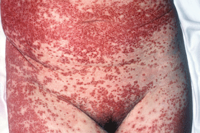 Pustules on the back possibly triggering toxic-shock syndrome