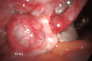 pelvic inflammatory disease
