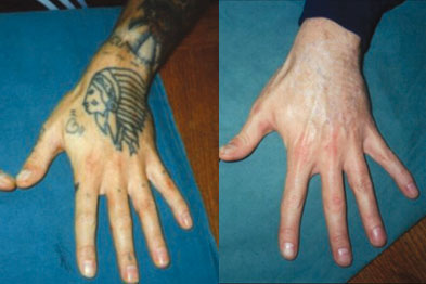 Tattoo Removal Before and After Photos  Goodbye Tattoos