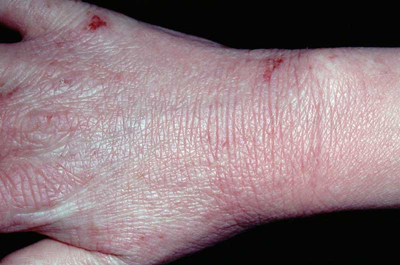 rash on knuckles