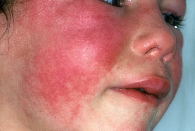 Parents and carers asked to be aware of the symptoms of scarlet fever