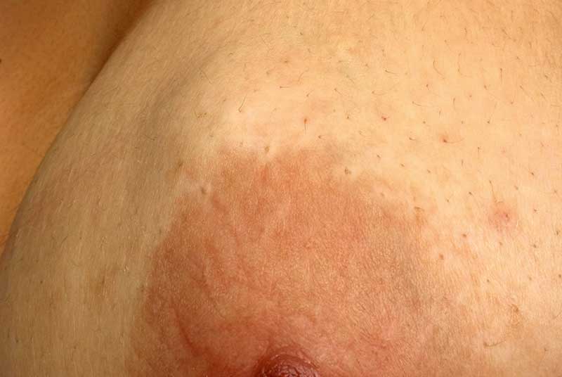 I found a breast cancer lump after noticing a red rash on boob as