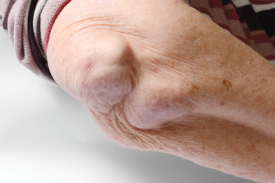 Timely diagnosis of rheumatoid arthritis | GPonline Timely diagnosis of rheumatoid arthritis | GPonline
