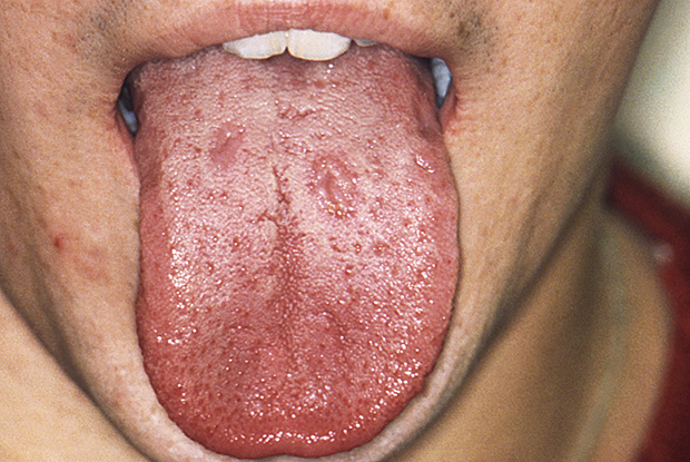 chlamydia in mouth