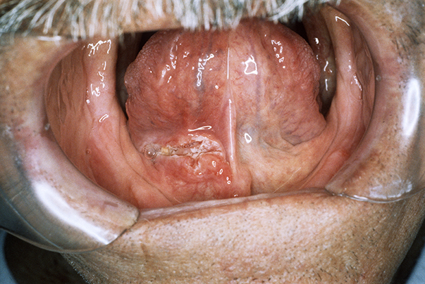 oral cancer under tongue