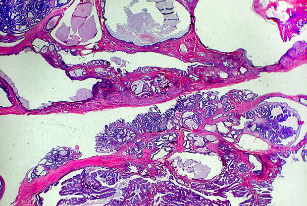 Closer Look at Postmenopausal Bleeding and Endometrial Cancer - NCI