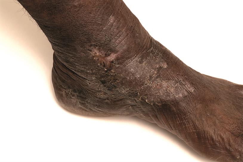 Sock-line Hyperpigmentation: Symptoms, Causes, Prevention