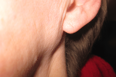 Close up of abscess Inflammation on the ear, area of suppuration.  Collection of pus that has built up within the tissue of the body. Photos