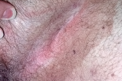 What causes rashes around the groin?
