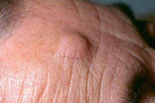 benign skin lesions