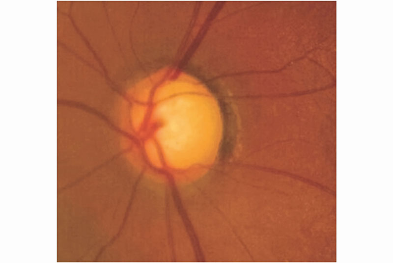 Clinical Review Glaucoma GPonline