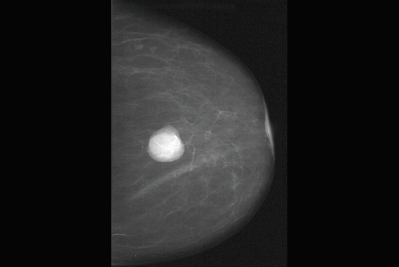 Clinical Review: Benign breast disease
