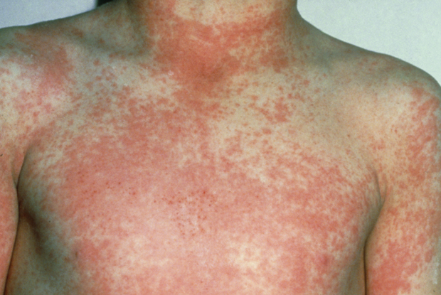 Scarlet fever cases surge to more than twice seasonal average