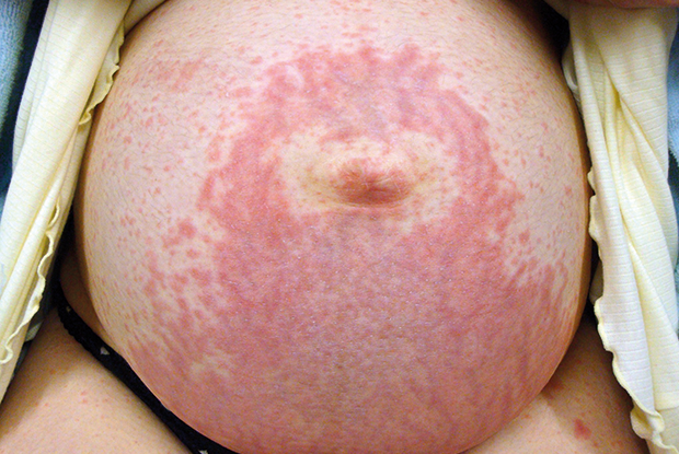 Rashes On Breast During Pregnancy: Causes, Treatment & Prevention