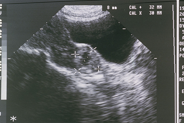 Thirty-seven-year-old female with ruptured ectopic pregnancy.