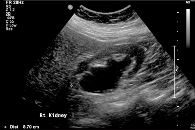 what do kidney stones look like on ultrasound