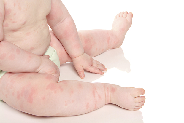 Acute erythematous rashes in children