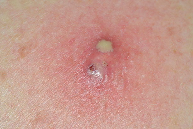 infected sebaceous cyst in scalp