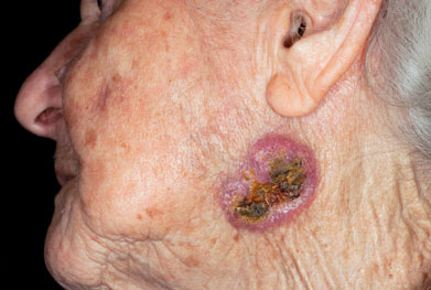 Advanced basal cell carcinoma on the face of an elderly woman | SCIENCE PHOTO LIBRARY