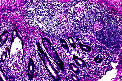 In addition to its Crohn's indication (pictured), Humira is also licensed for ulcerative colitis  | SCIENCE PHOTO LIBRARY