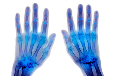 In addition to rheumatoid arthritis, ocrelizumab is being studied in other autoimmune diseases including multiple sclerosis and lupus nephritis. (Photograph: DU CANE MEDICAL IMAGING LTD / SCIENCE PHOTO LIBRARY).