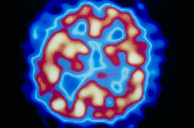 Manic episodes in bipolar disorder vary in intensity from mild mania to full-blown psychotic features including hallucinations (visible here as yellow areas of high brain activity on a PET scan of the temporal lobe).