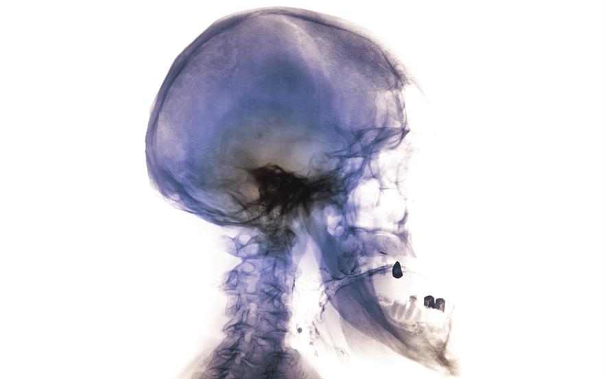 Acromegaly leads to uncontrolled enlargement of the hands and feet, a jutting out jaw and lengthened facial features. | SCIENCE PHOTO LIBRARY