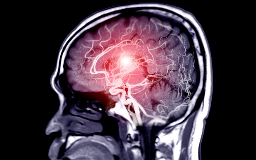 Fusion image of MRA of cerebral artery in the brain. 