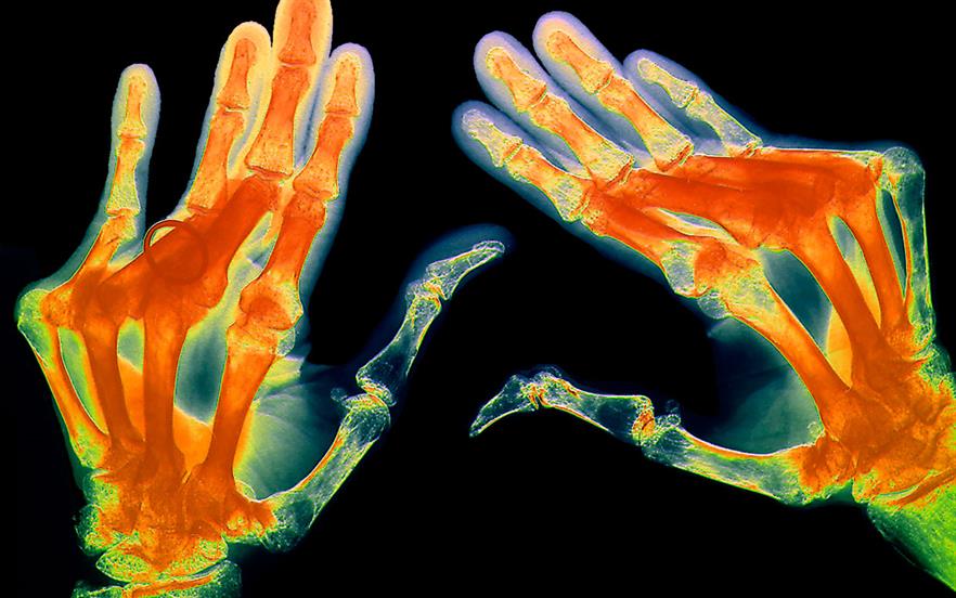 This new guidance brings the drug in line with other anti-TNF drugs licensed for the treatment of rheumatoid arthritis (pictured) that have been approved by NICE for NHS use | SCIENCE PHOTO LIBRARY
