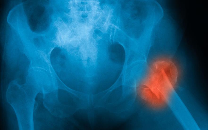 Previous research looking at the impact of steroids on bone health has proved inconclusive. | GETTY IMAGES