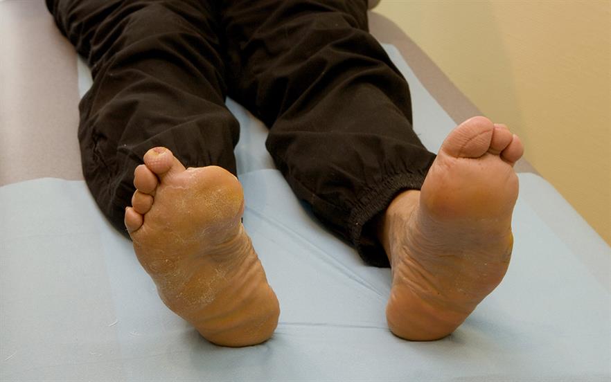SGLT2 inhibitors may increase the risk of lower-limb amputation. | B. BOISSONNET/ SCIENCE PHOTO LIBRARY