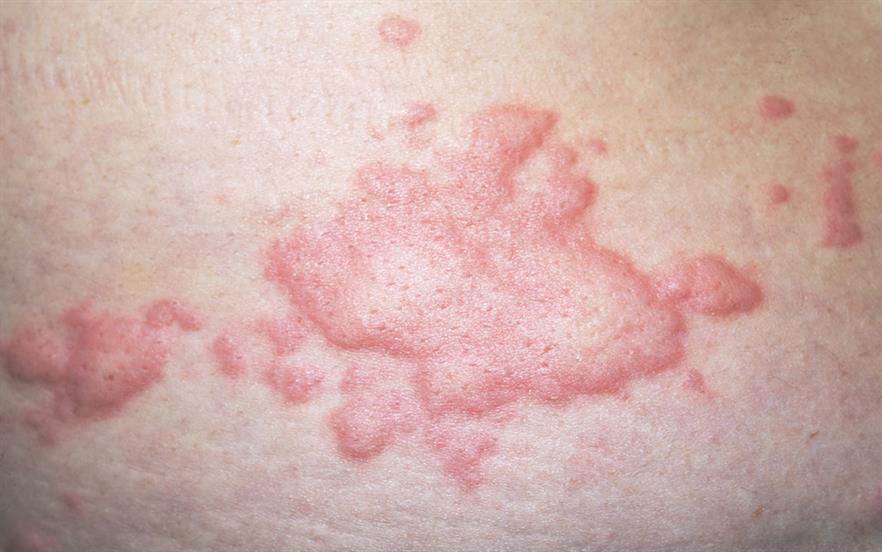 Urticaria must be objectively diagnosed as severe before treatment with omalizumab can commence. | SCIENCE PHOTO LIBRARY 